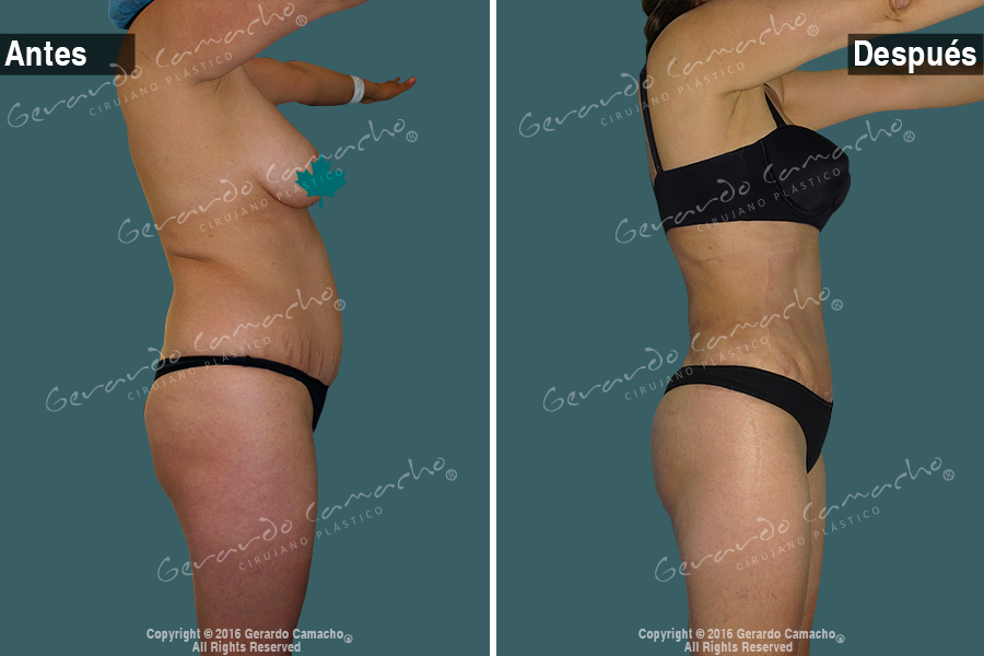 Procedimiento de abdominoplastia avanzada en Bogotá